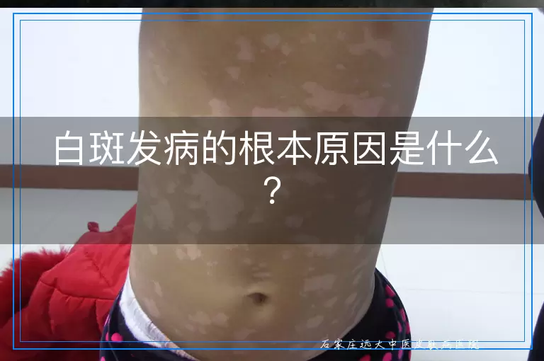 白斑发病的根本原因是什么？