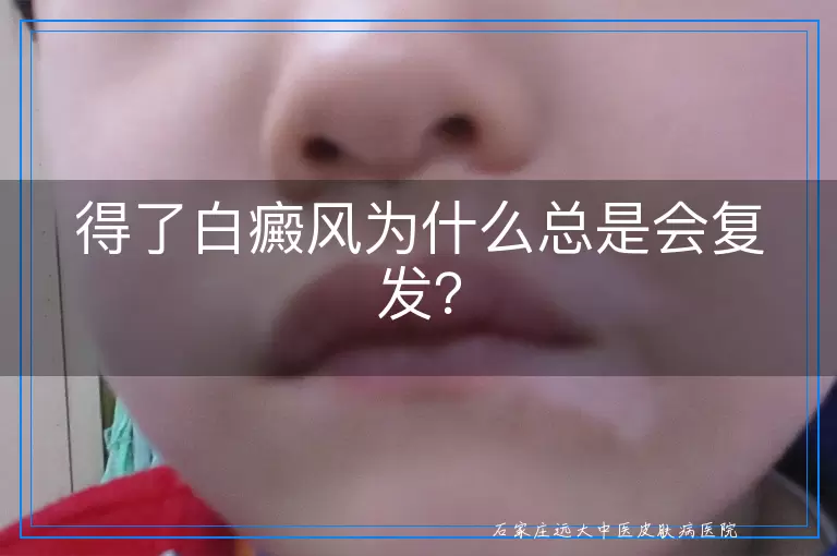 得了白癜风为什么总是会复发？