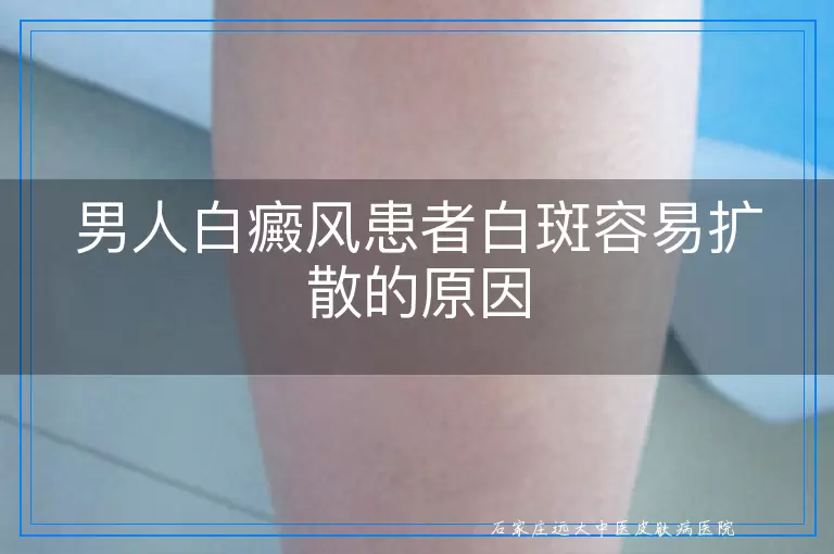 男人白癜风患者白斑容易扩散的原因