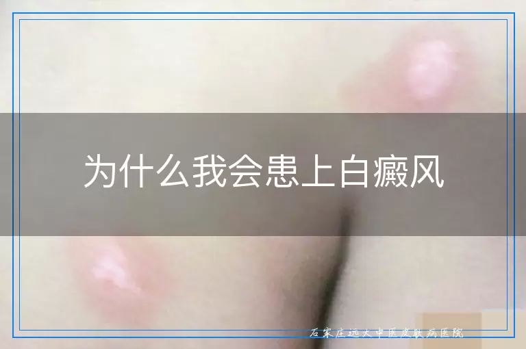 为什么我会患上白癜风