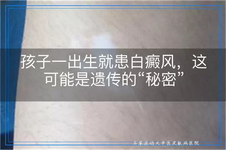 孩子一出生就患白癜风，这可能是遗传的“秘密”