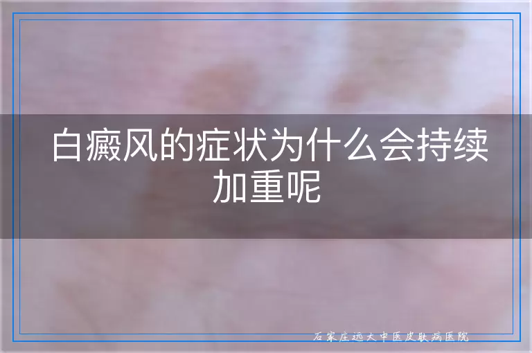 白癜风的症状为什么会持续加重呢