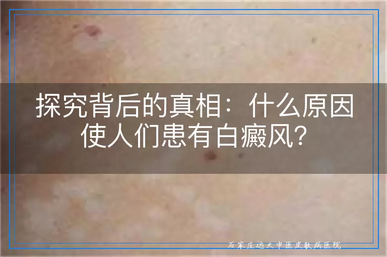 探究背后的真相：什么原因使人们患有白癜风？