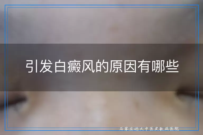 引发白癜风的原因有哪些