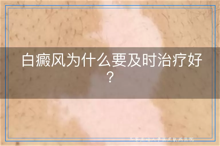 白癜风为什么要及时治疗好？