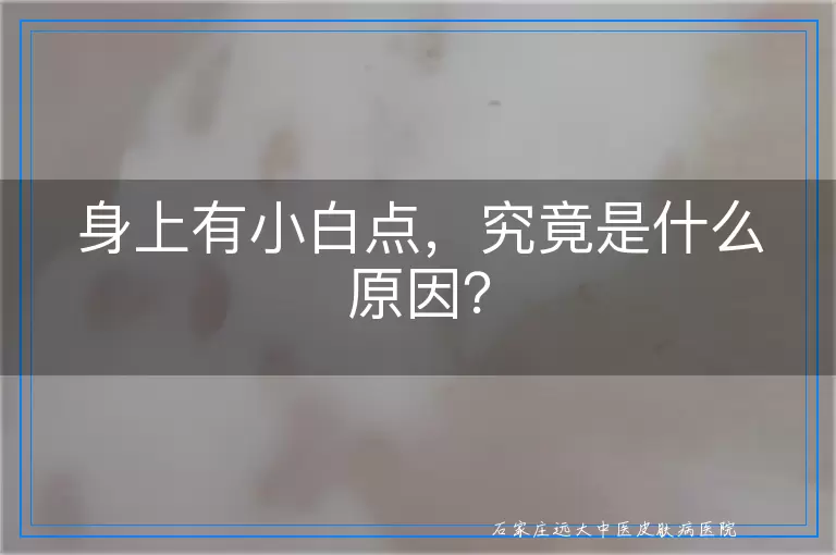 身上有小白点，究竟是什么原因？