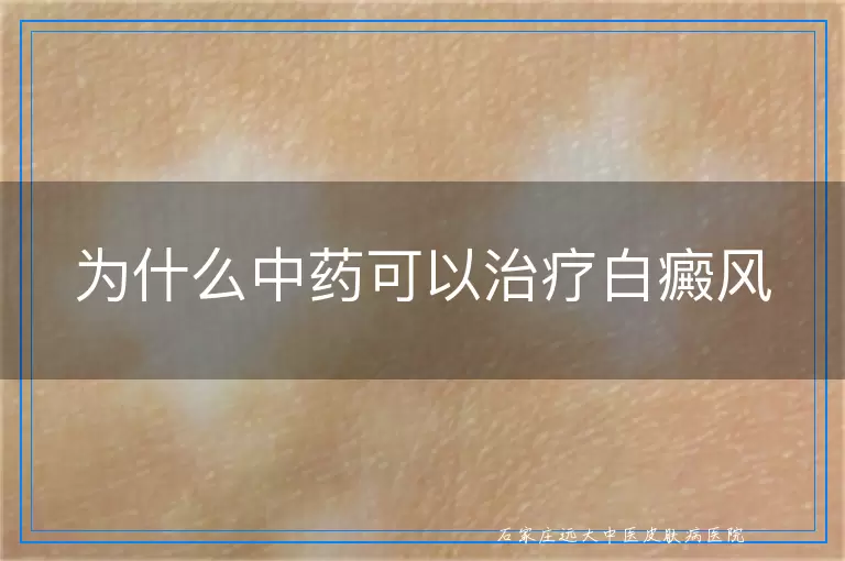 为什么中药可以治疗白癜风