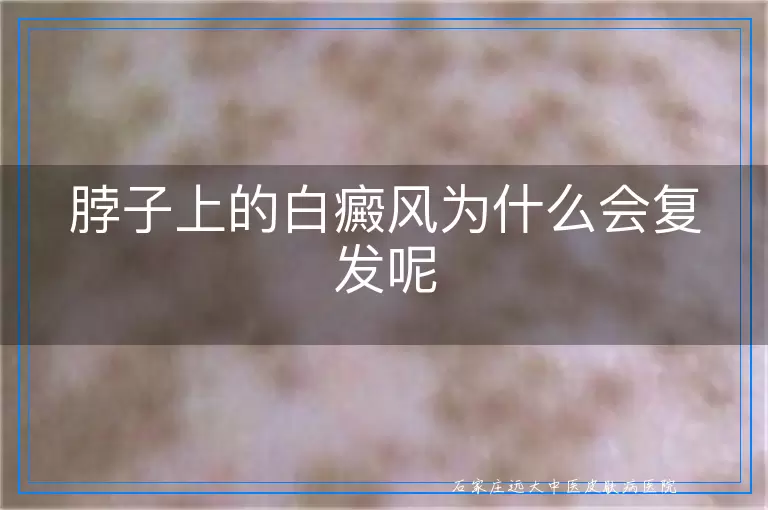 脖子上的白癜风为什么会复发呢