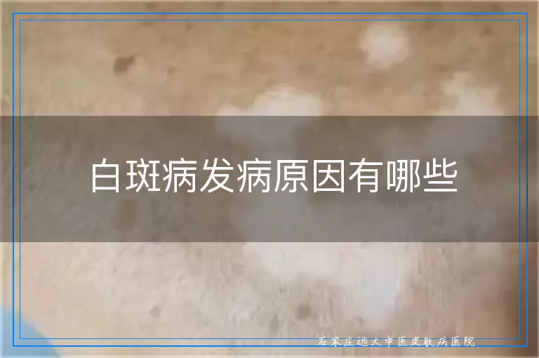 白斑病发病原因有哪些
