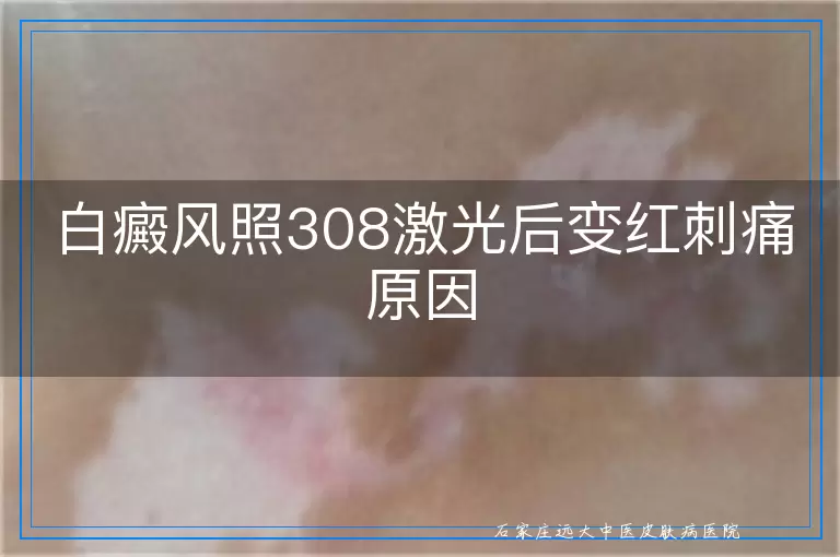 白癜风照308激光后变红刺痛原因