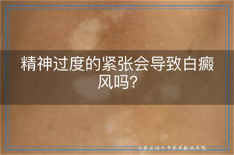 精神过度的紧张会导致白癜风吗？