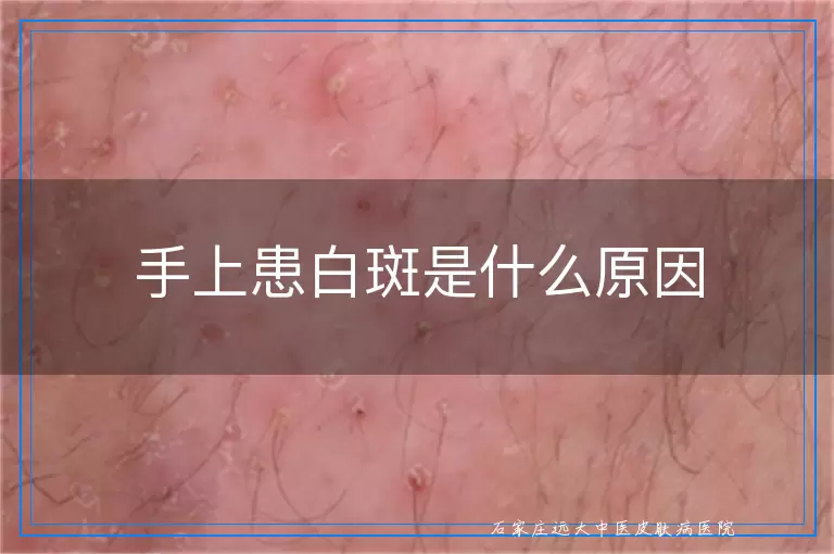 手上患白斑是什么原因