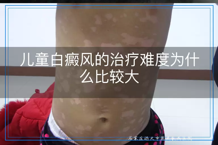 儿童白癜风的治疗难度为什么比较大