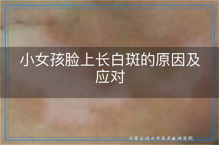 小女孩脸上长白斑的原因及应对