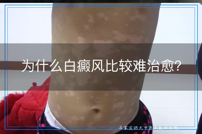 为什么白癜风比较难治愈？