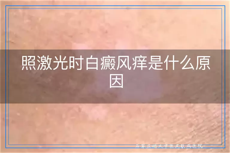 照激光时白癜风痒是什么原因