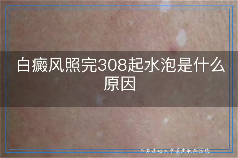白癜风照完308起水泡是什么原因