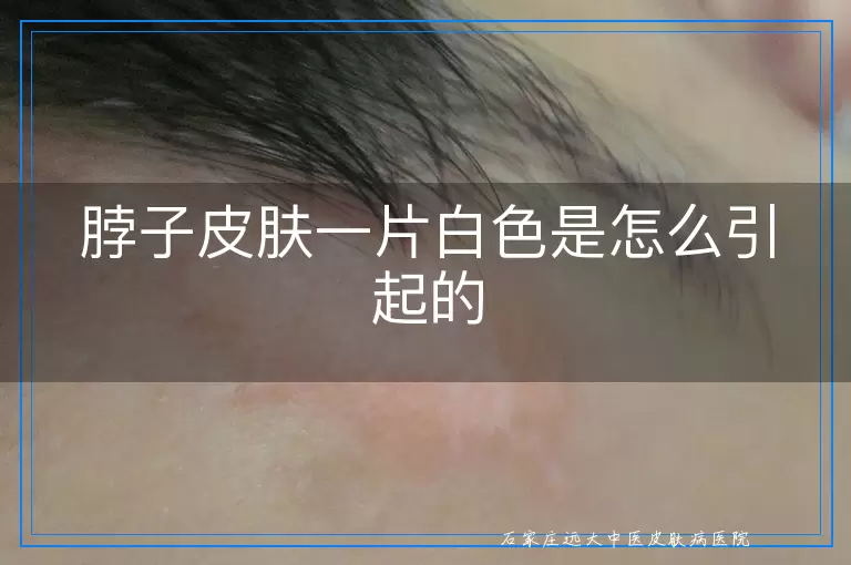 脖子皮肤一片白色是怎么引起的