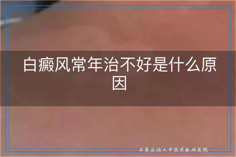 白癜风常年治不好是什么原因