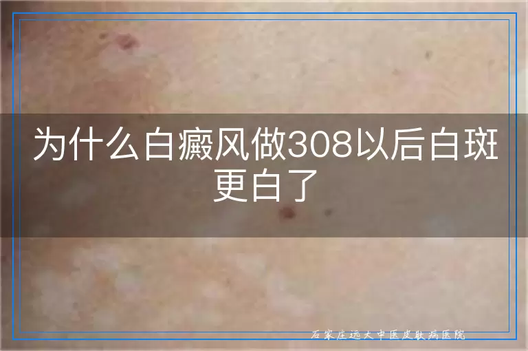 为什么白癜风做308以后白斑更白了