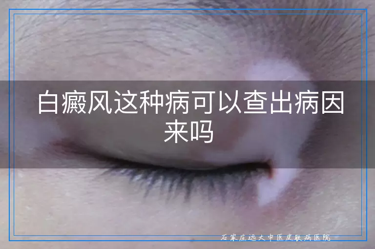 白癜风这种病可以查出病因来吗