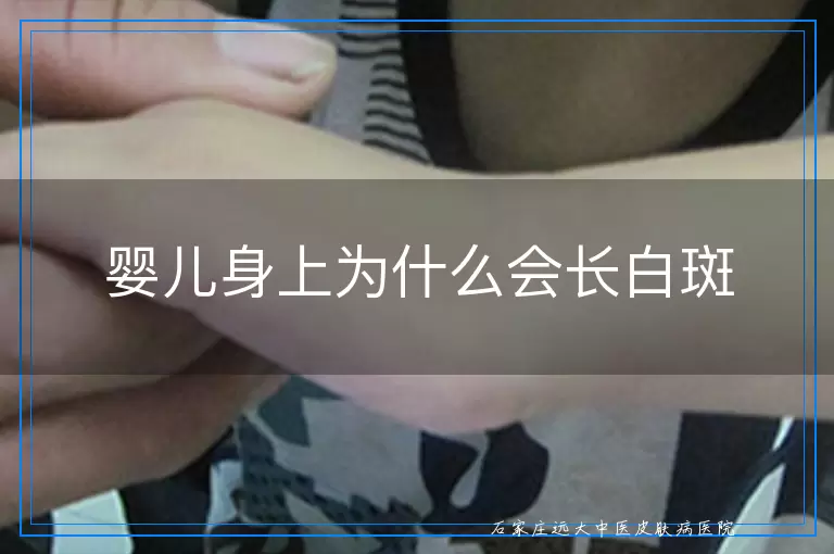 婴儿身上为什么会长白斑