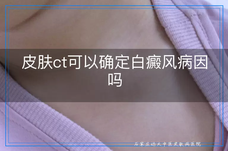 皮肤ct可以确定白癜风病因吗