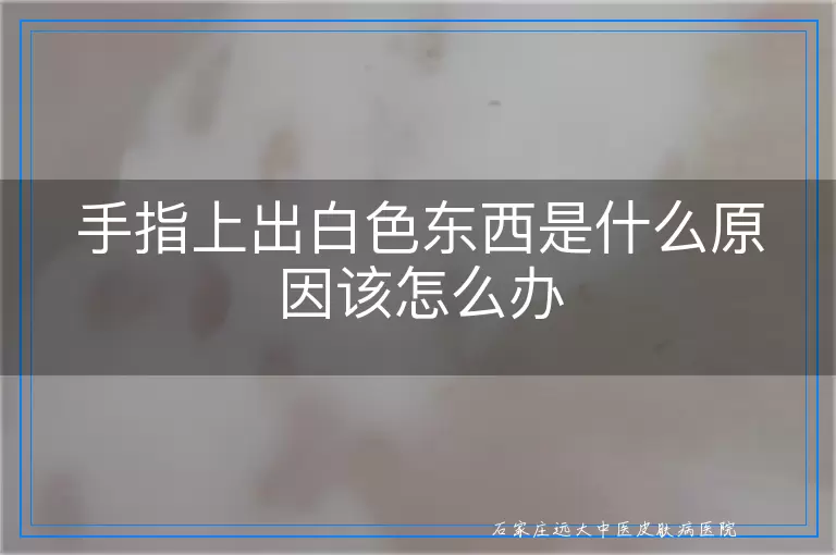 手指上出白色东西是什么原因该怎么办