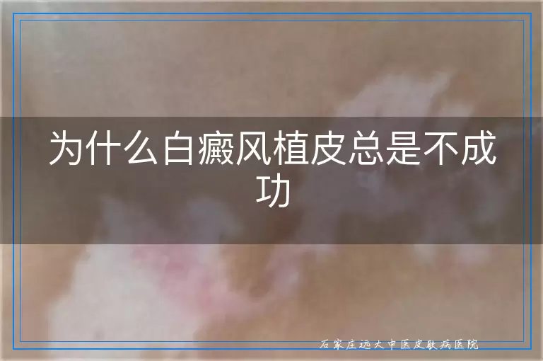 为什么白癜风植皮总是不成功