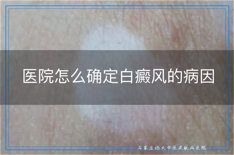 医院怎么确定白癜风的病因