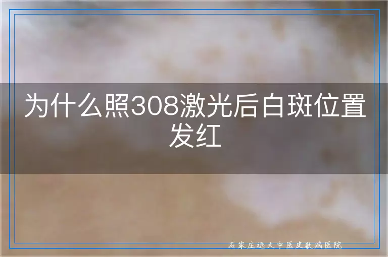 为什么照308激光后白斑位置发红