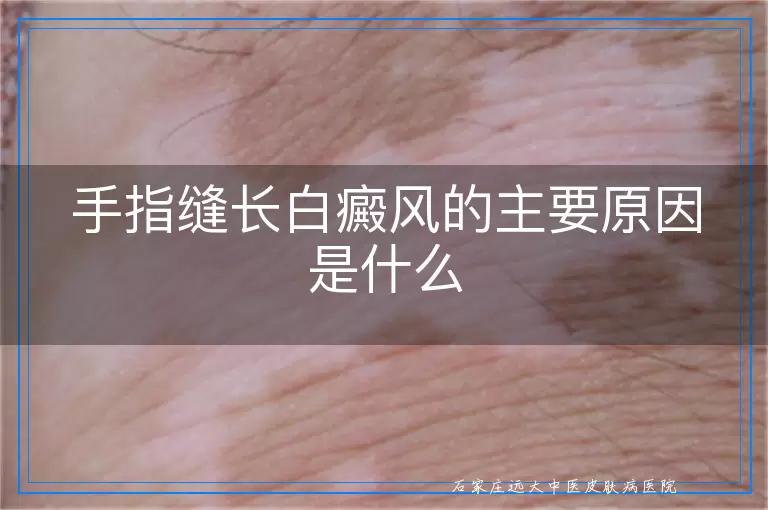 手指缝长白癜风的主要原因是什么