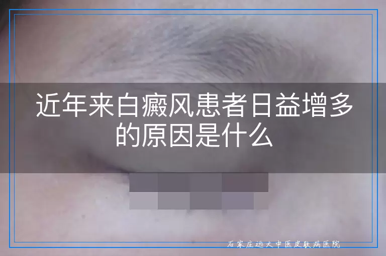 近年来白癜风患者日益增多的原因是什么