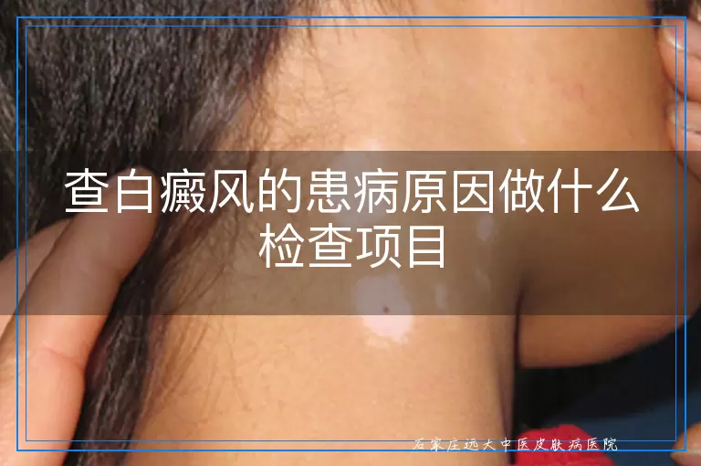 查白癜风的患病原因做什么检查项目