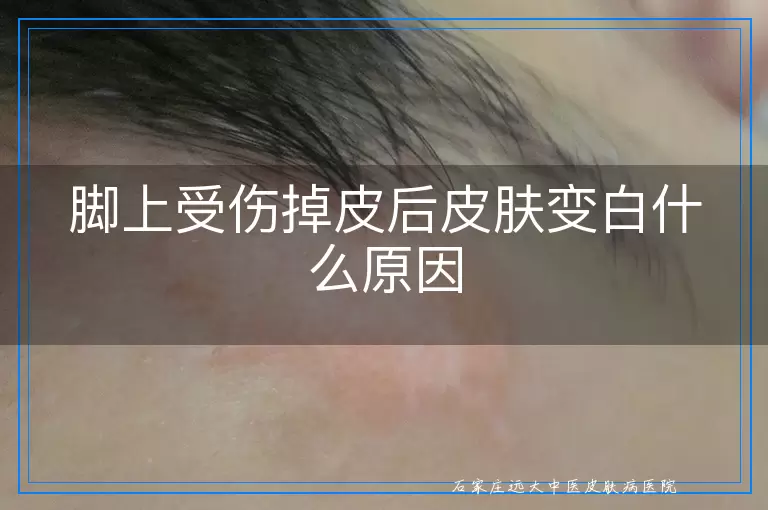 脚上受伤掉皮后皮肤变白什么原因