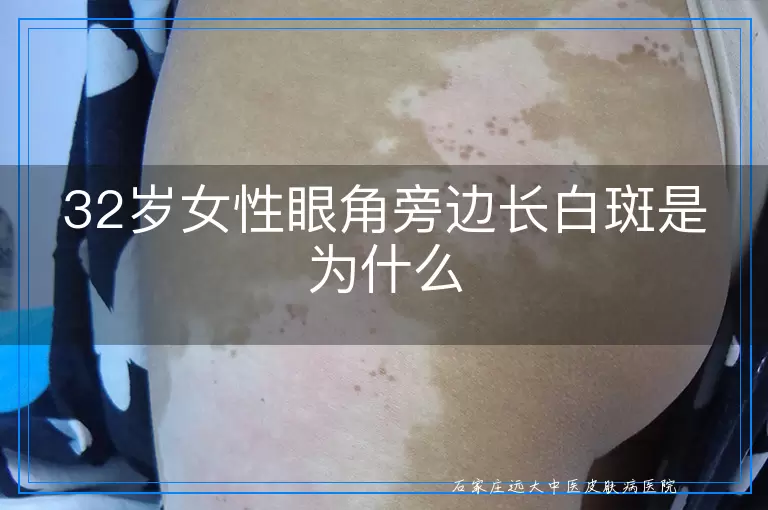 32岁女性眼角旁边长白斑是为什么