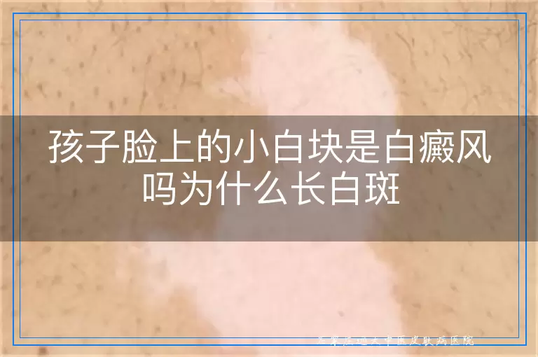 孩子脸上的小白块是白癜风吗为什么长白斑