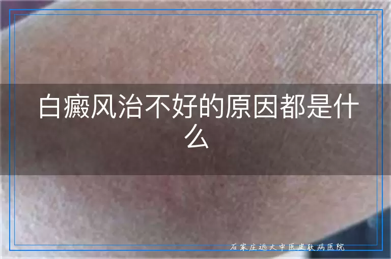 白癜风治不好的原因都是什么