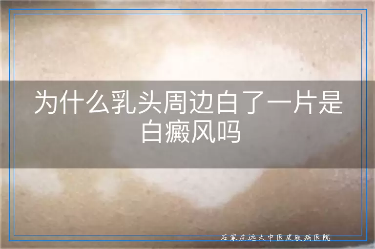 为什么乳头周边白了一片是白癜风吗