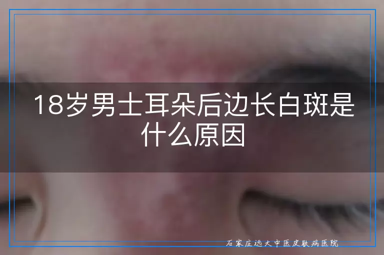 18岁男士耳朵后边长白斑是什么原因
