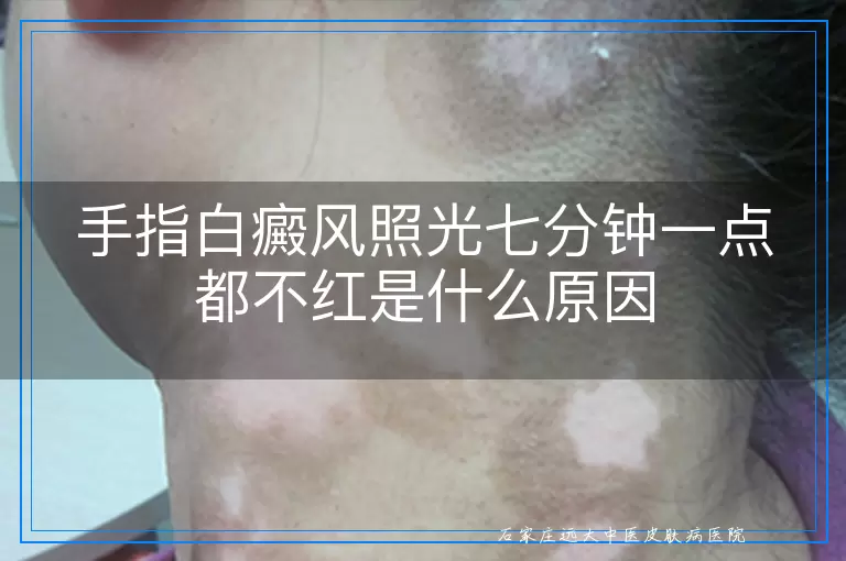 手指白癜风照光七分钟一点都不红是什么原因