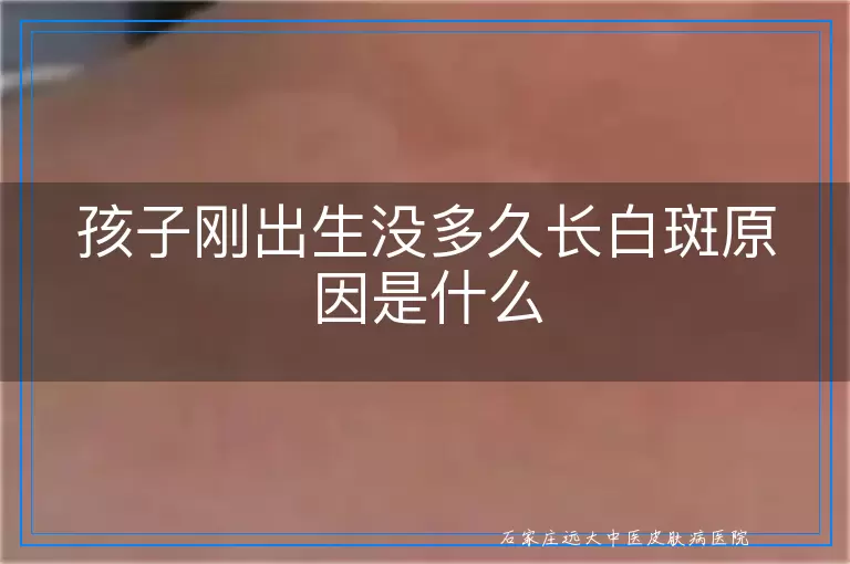 孩子刚出生没多久长白斑原因是什么
