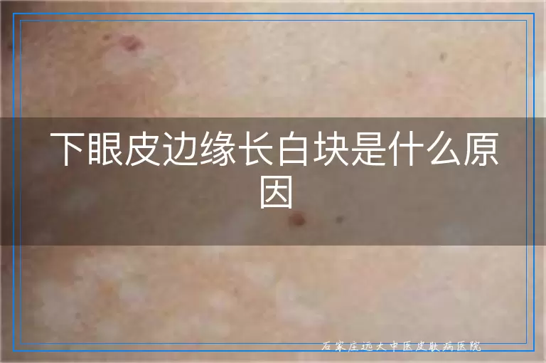 下眼皮边缘长白块是什么原因