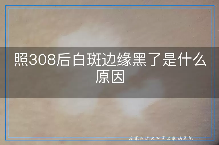 照308后白斑边缘黑了是什么原因