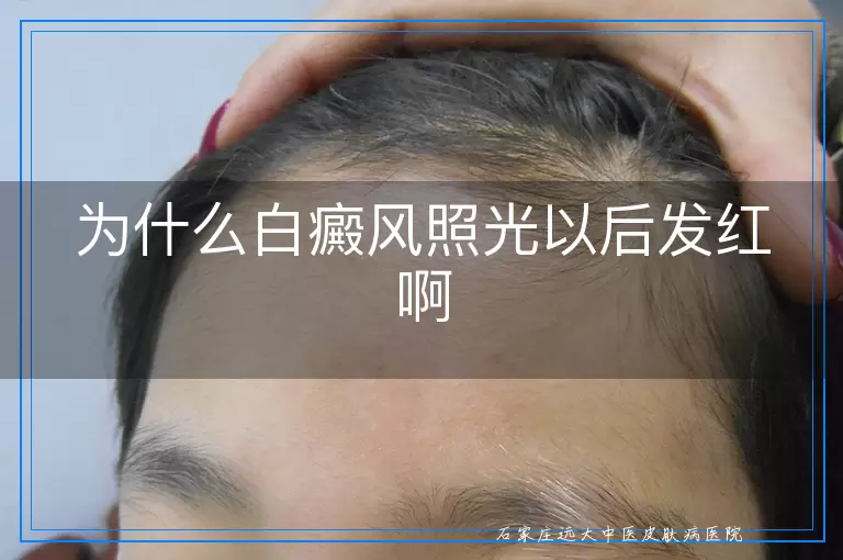 为什么白癜风照光以后发红啊