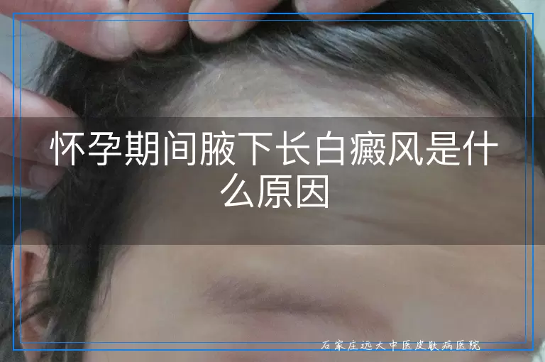 怀孕期间腋下长白癜风是什么原因