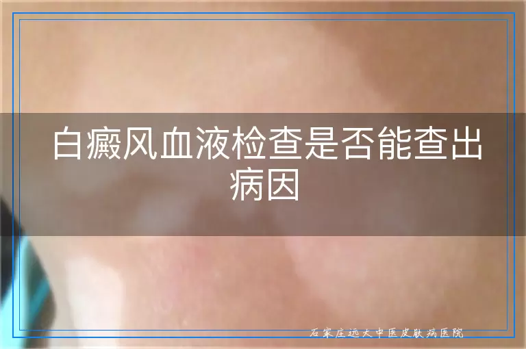 白癜风血液检查是否能查出病因