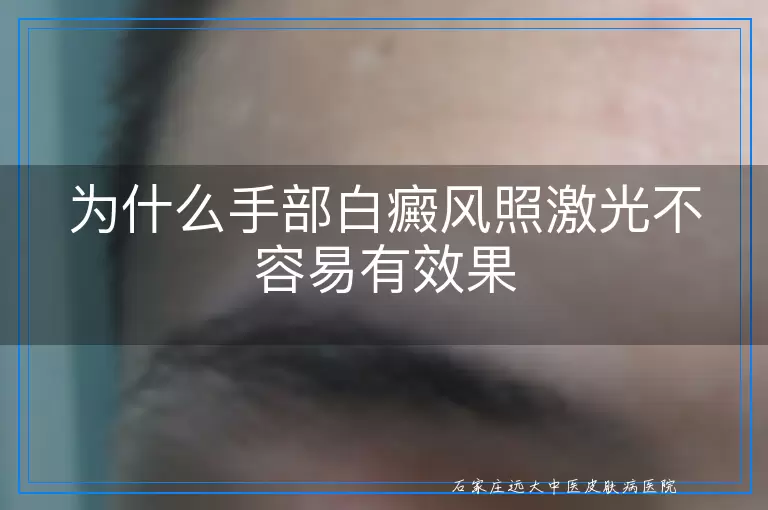 为什么手部白癜风照激光不容易有效果