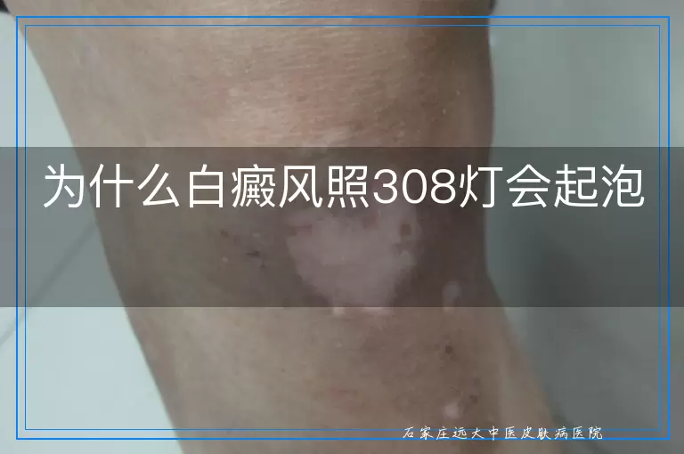 为什么白癜风照308灯会起泡