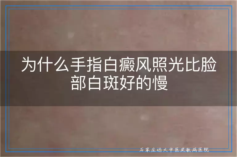 为什么手指白癜风照光比脸部白斑好的慢